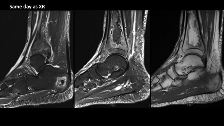 Figure 2 for case osteonecrosis ( RID5180 )
